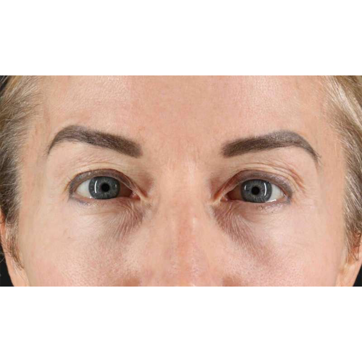 Blepharoplasty (Eyelid Surgery) Before & After Patient #10694
