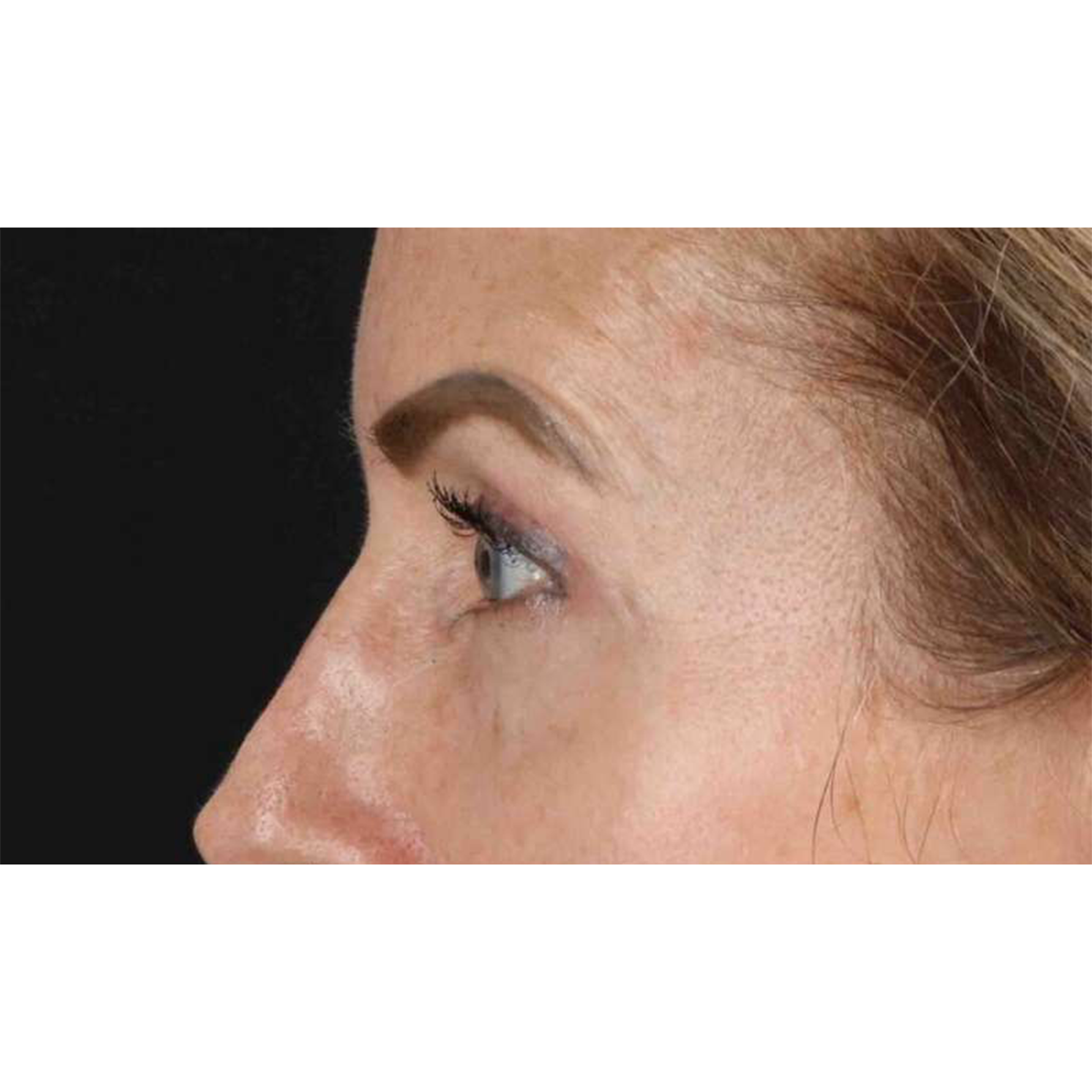 Blepharoplasty (Eyelid Surgery) Before & After Patient #10694