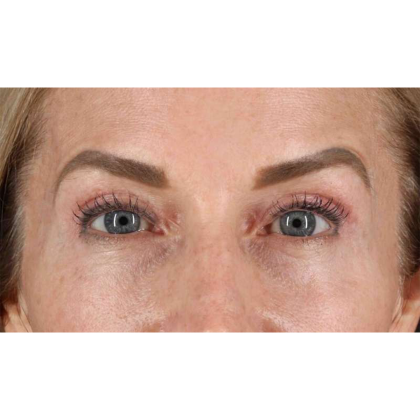 Blepharoplasty (Eyelid Surgery) Before & After Patient #10694
