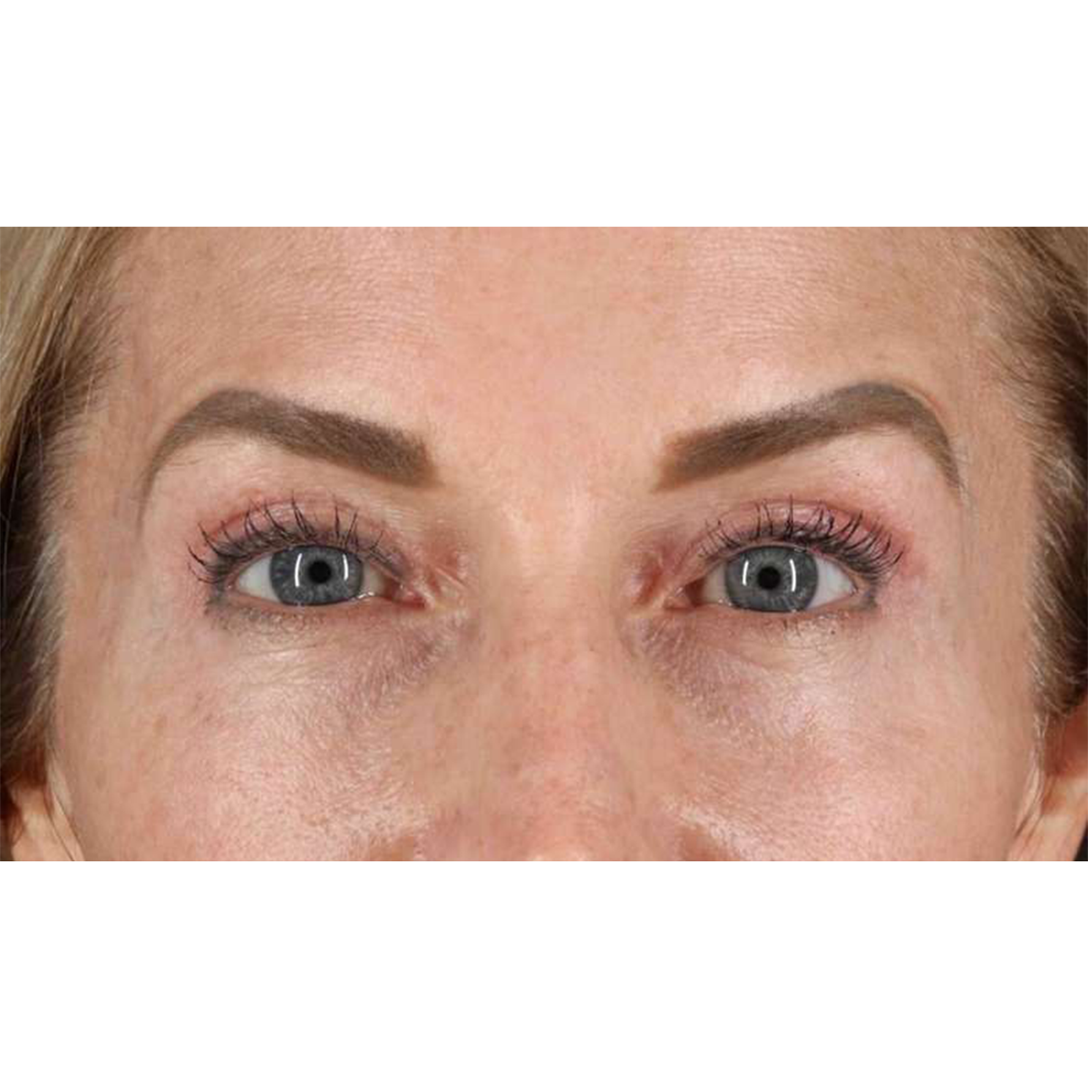 Blepharoplasty (Eyelid Surgery) Before & After Patient #10694