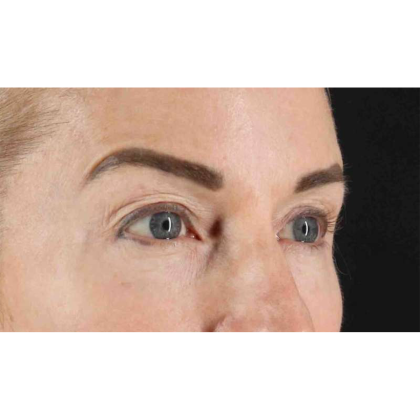 Blepharoplasty (Eyelid Surgery) Before & After Patient #10694