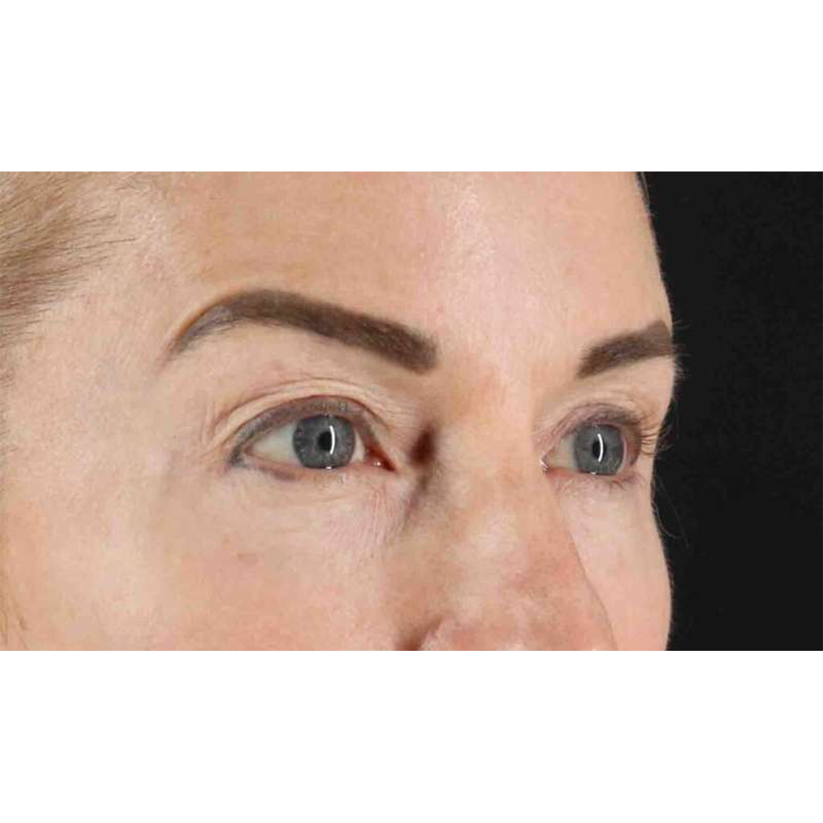 Blepharoplasty (Eyelid Surgery) Before & After Patient #10694