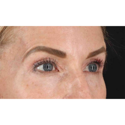 Blepharoplasty (Eyelid Surgery) Before & After Patient #10694