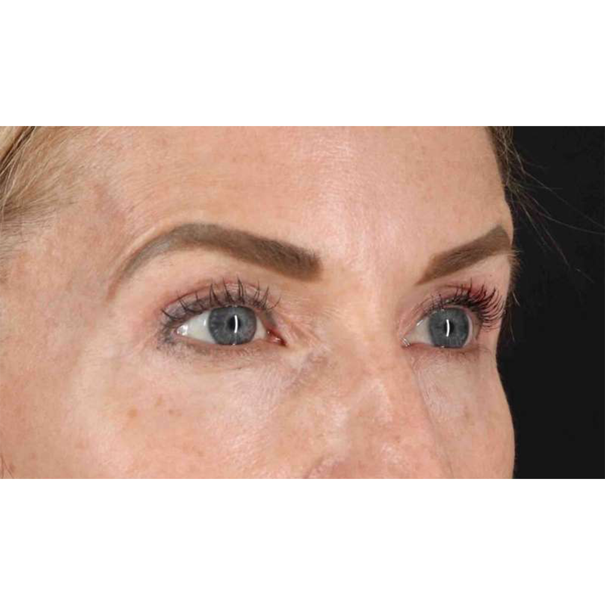Blepharoplasty (Eyelid Surgery) Before & After Patient #10694