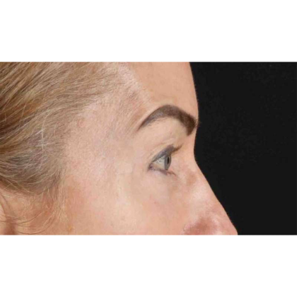 Blepharoplasty (Eyelid Surgery) Before & After Patient #10694