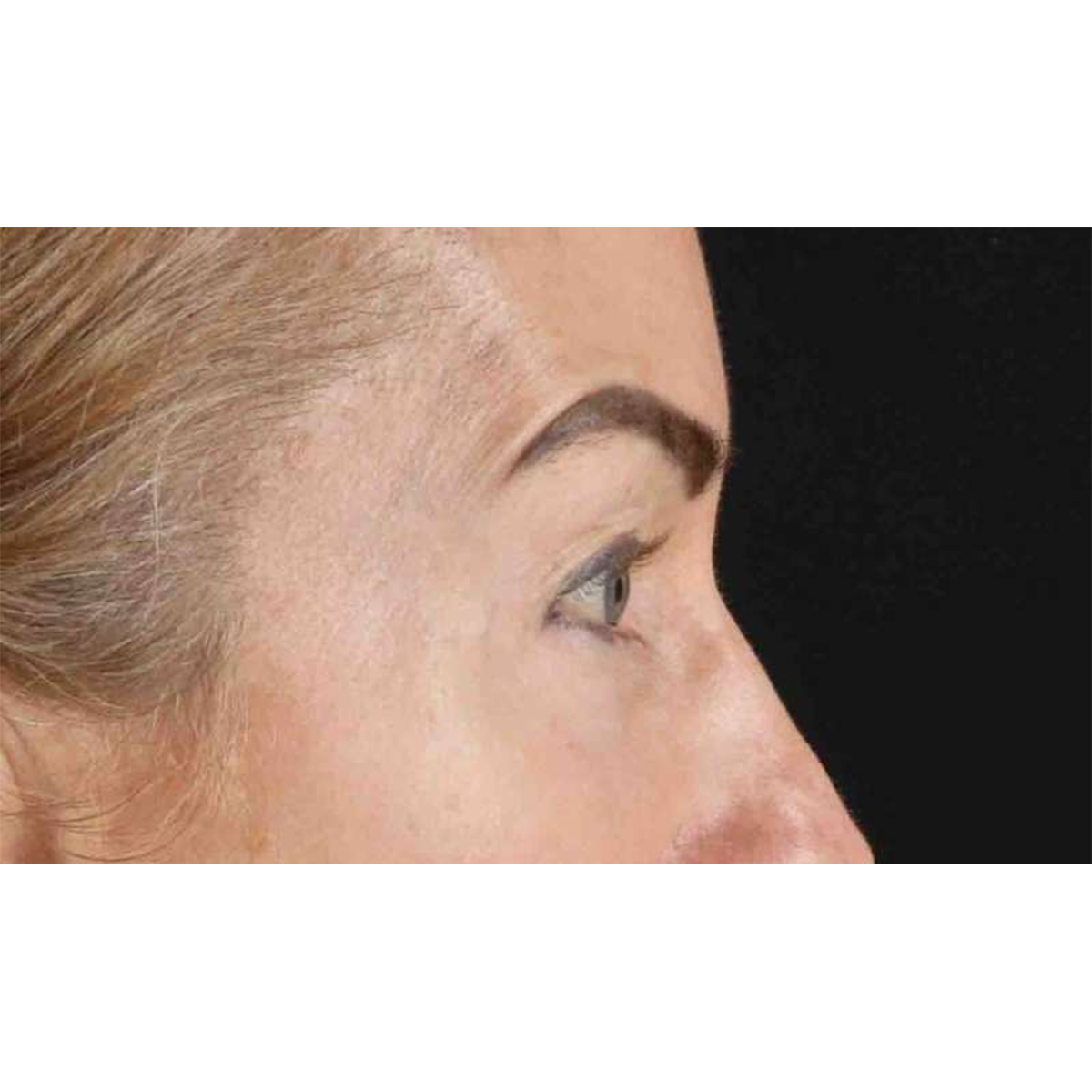 Blepharoplasty (Eyelid Surgery) Before & After Patient #10694
