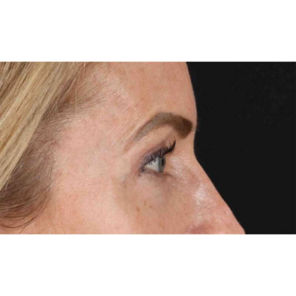 Blepharoplasty (Eyelid Surgery) Before & After Patient #10694