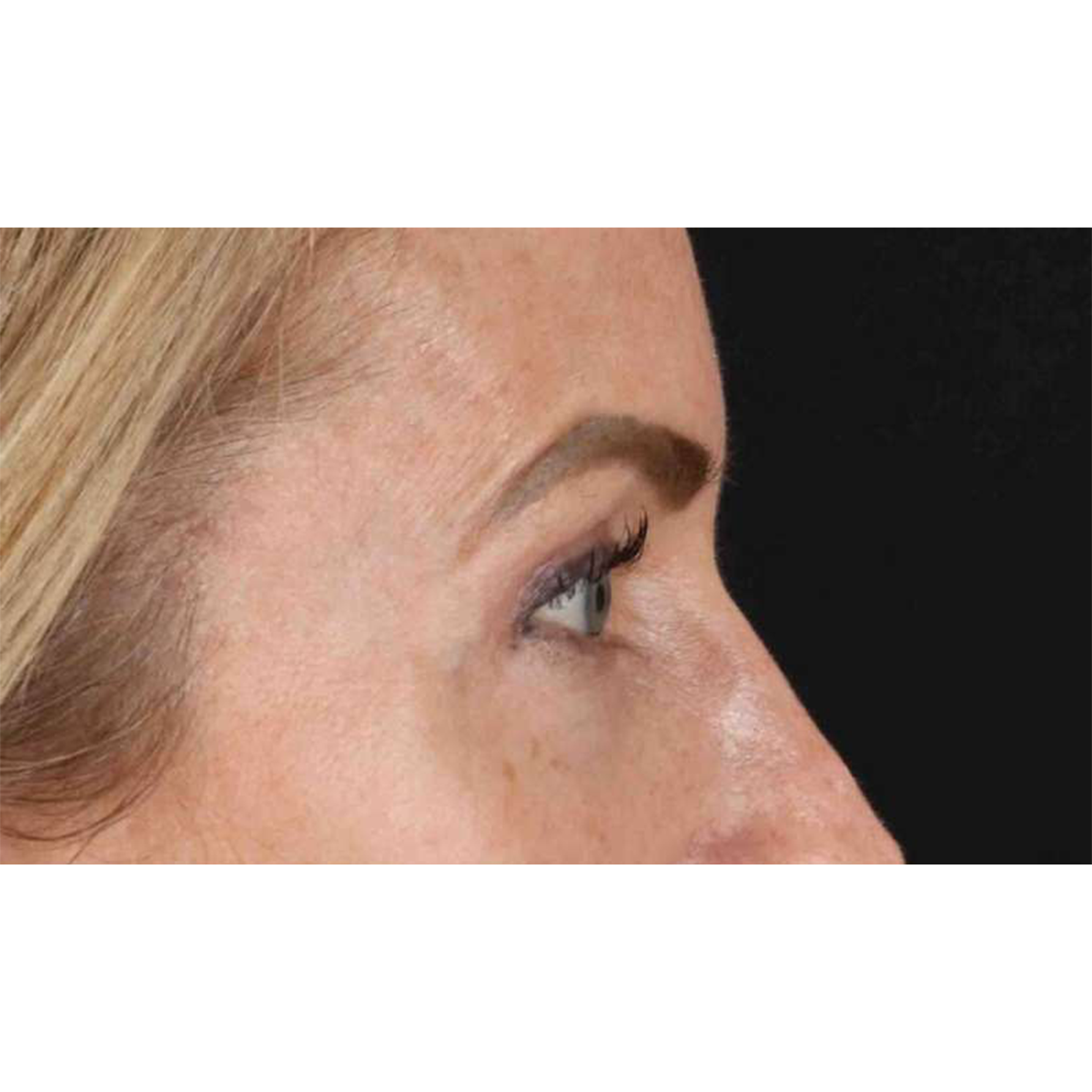Blepharoplasty (Eyelid Surgery) Before & After Patient #10694