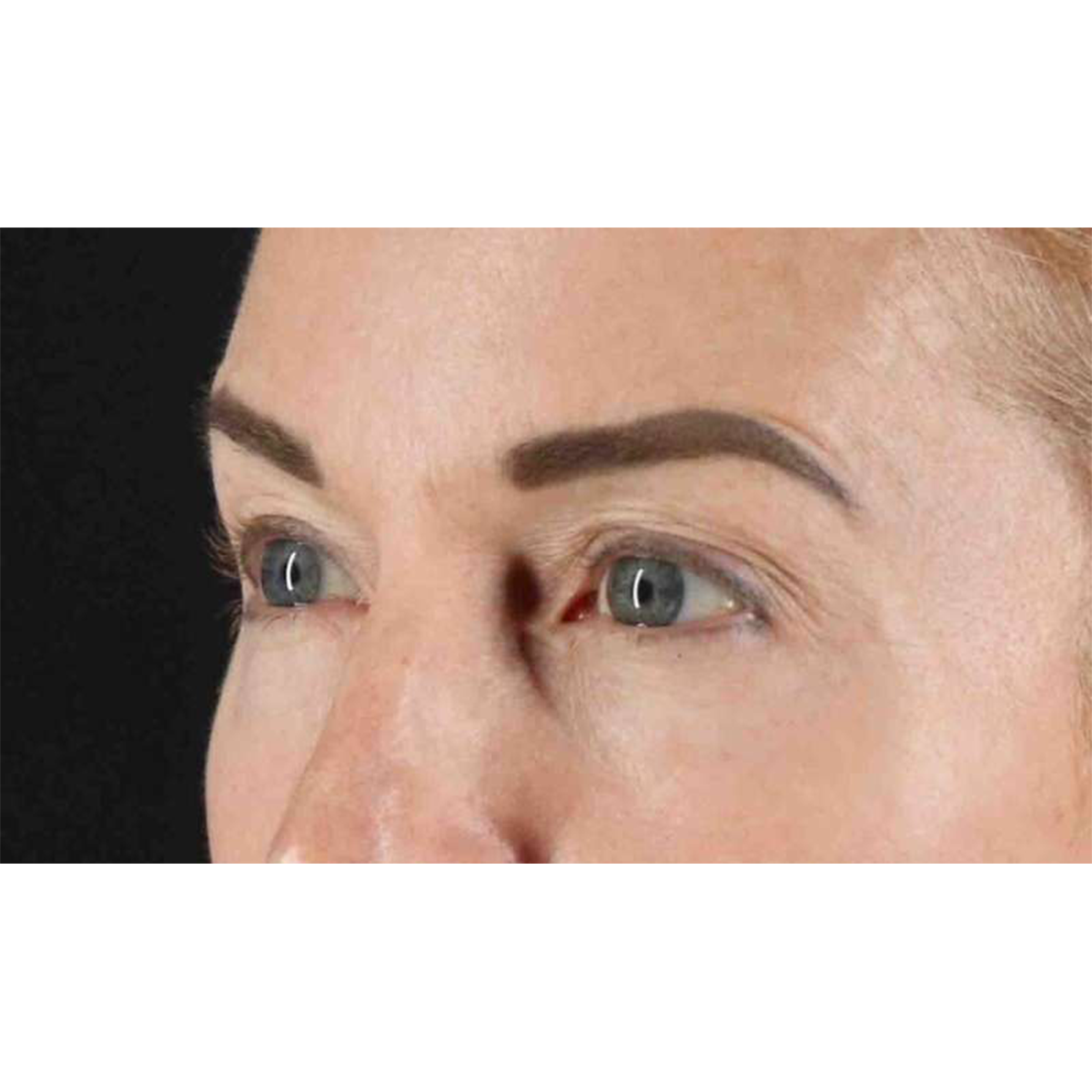 Blepharoplasty (Eyelid Surgery) Before & After Patient #10694