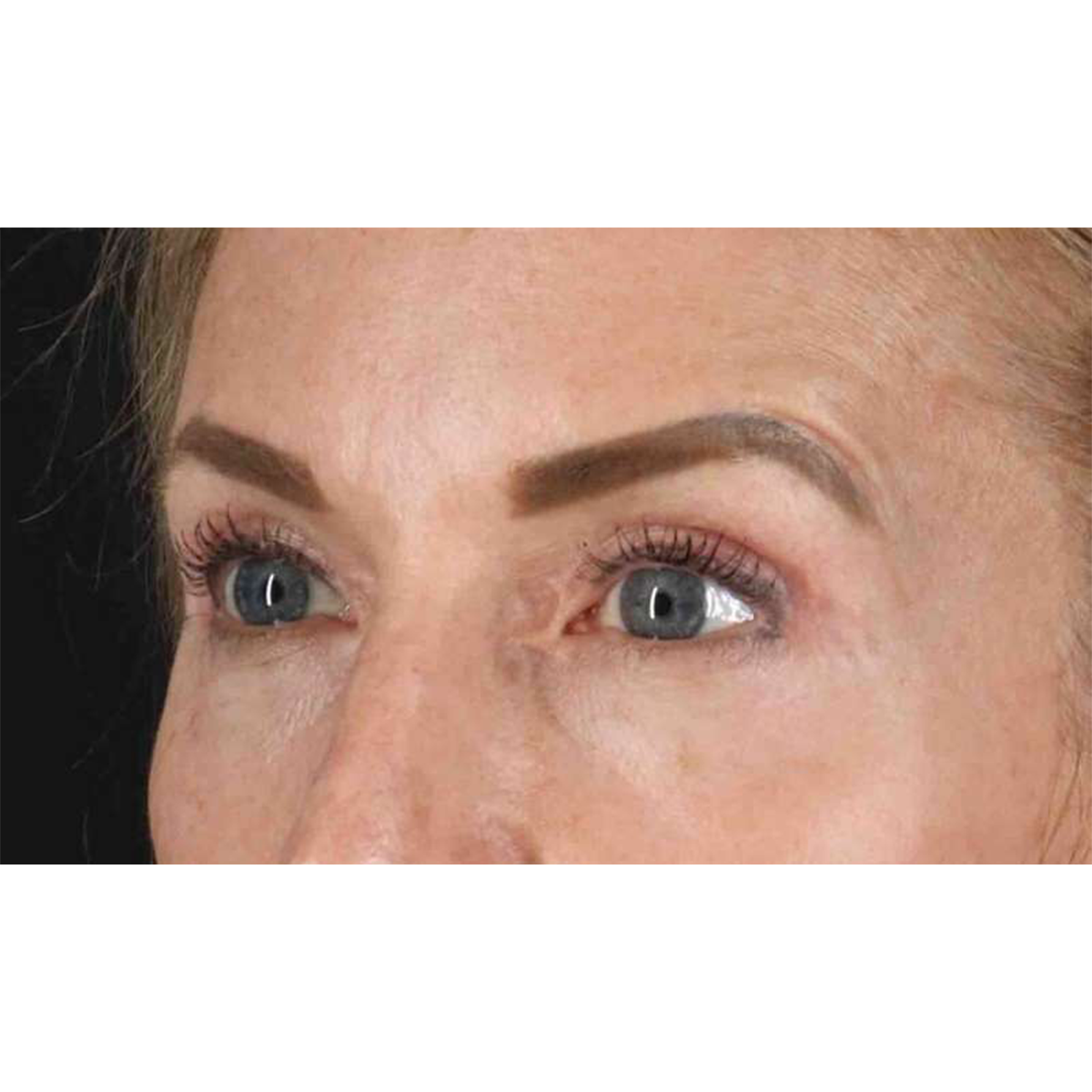 Blepharoplasty (Eyelid Surgery) Before & After Patient #10694