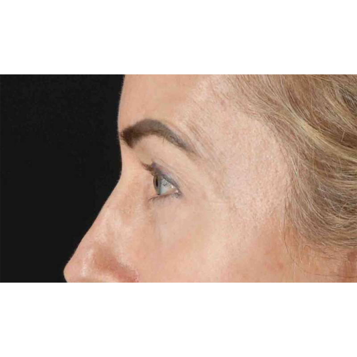 Blepharoplasty (Eyelid Surgery) Before & After Patient #10694