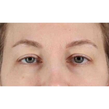 Blepharoplasty (Eyelid Surgery) Before & After Patient #10683
