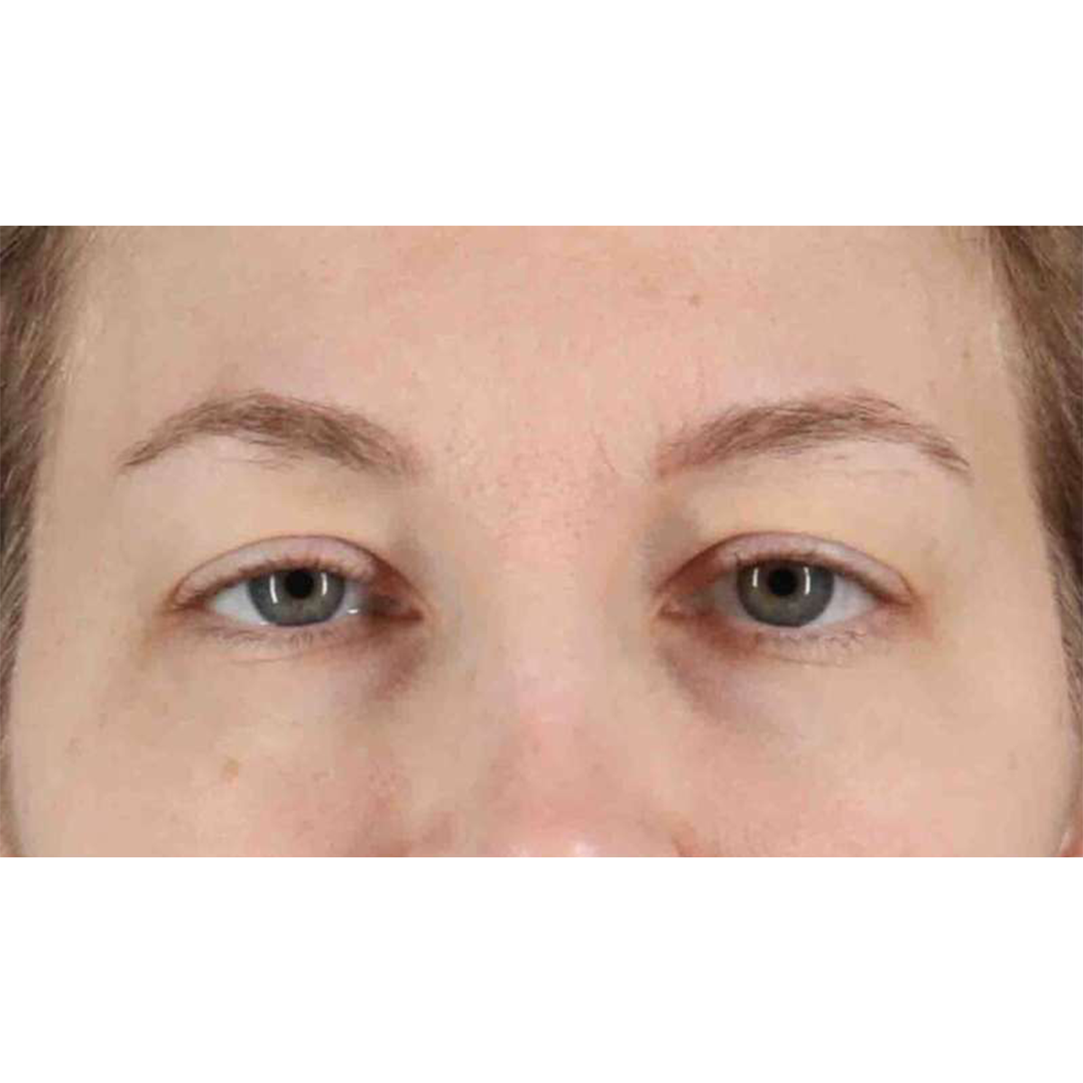 Blepharoplasty (Eyelid Surgery) Before & After Patient #10683