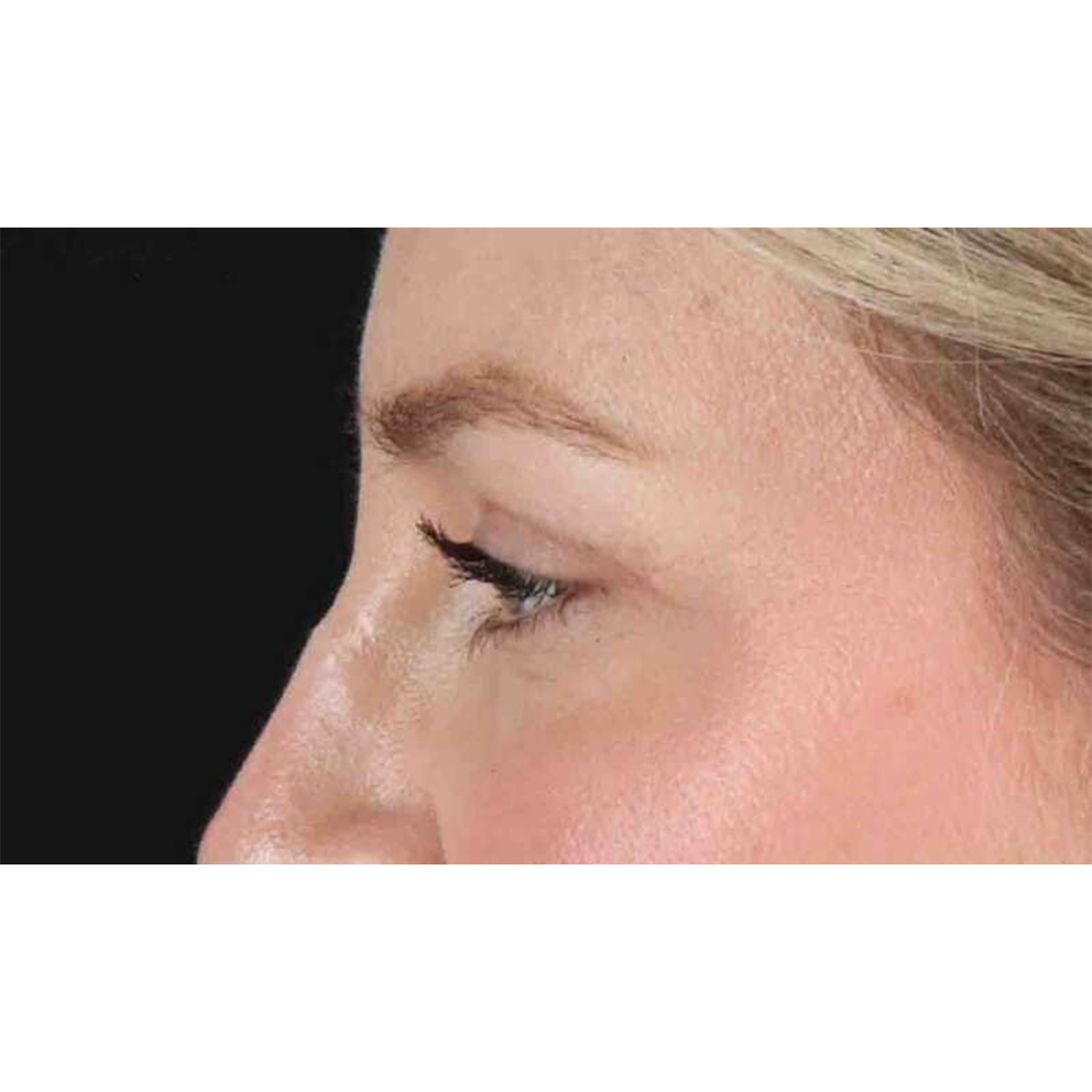 Blepharoplasty (Eyelid Surgery) Before & After Patient #10683