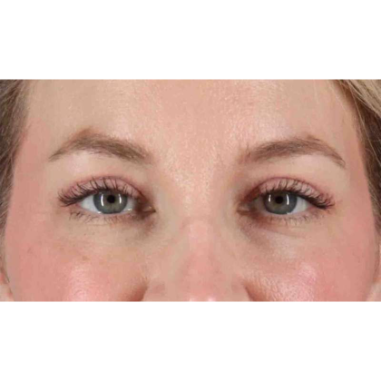 Blepharoplasty (Eyelid Surgery) Before & After Patient #10683