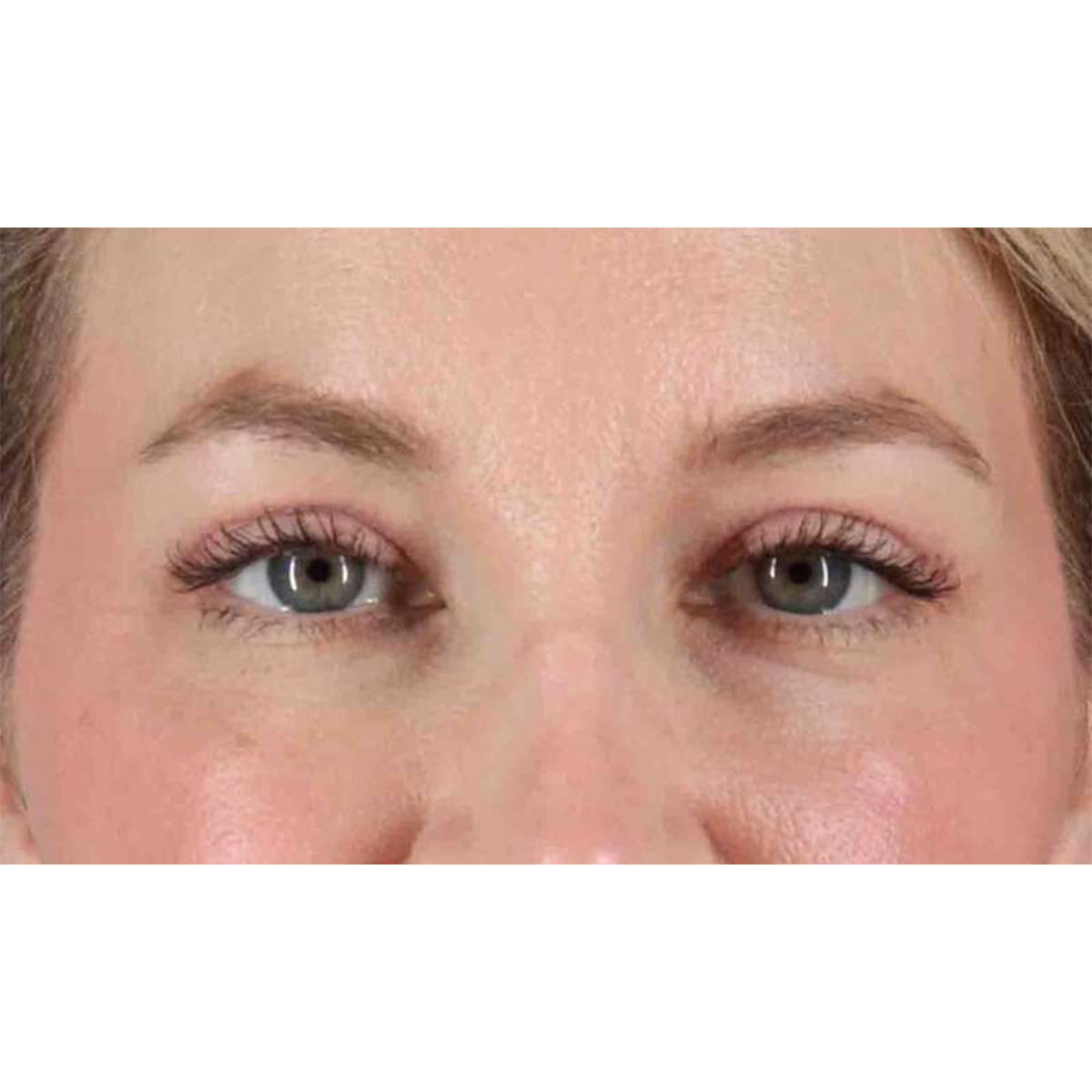 Blepharoplasty (Eyelid Surgery) Before & After Patient #10683