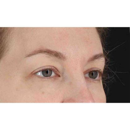 Blepharoplasty (Eyelid Surgery) Before & After Patient #10683