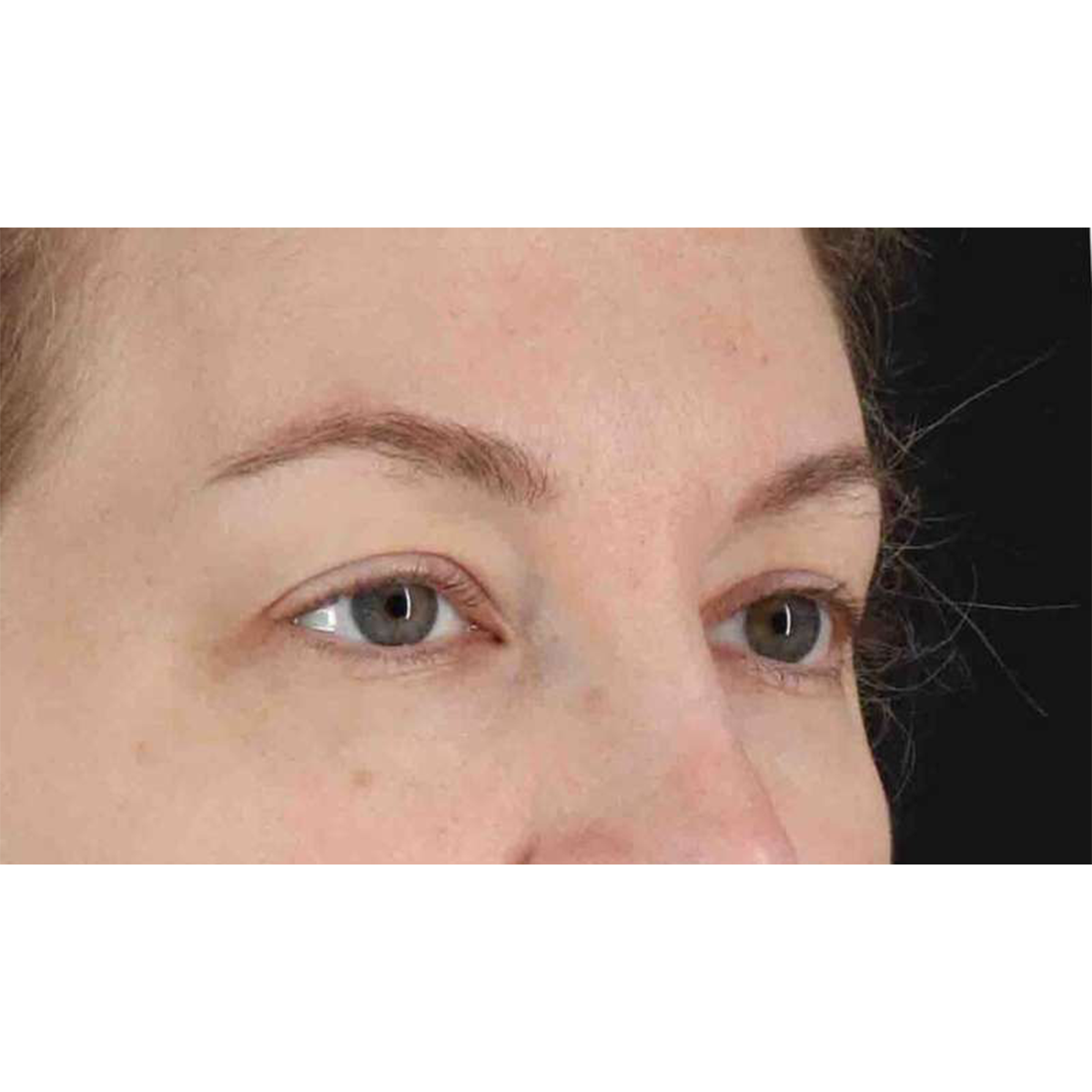 Blepharoplasty (Eyelid Surgery) Before & After Patient #10683