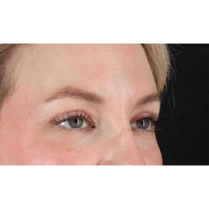 Blepharoplasty (Eyelid Surgery) Before & After Patient #10683