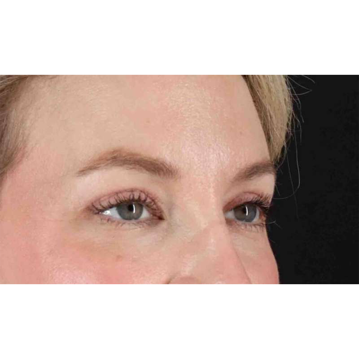 Blepharoplasty (Eyelid Surgery) Before & After Patient #10683