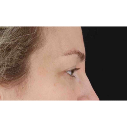 Blepharoplasty (Eyelid Surgery) Before & After Patient #10683