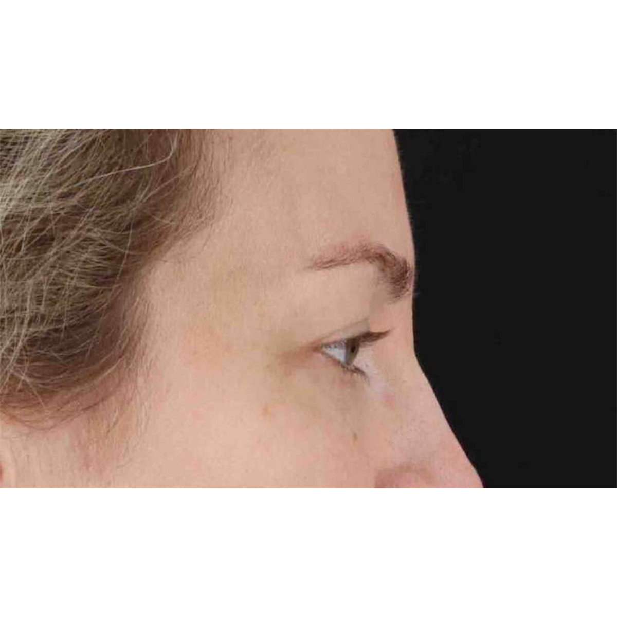 Blepharoplasty (Eyelid Surgery) Before & After Patient #10683