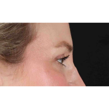 Blepharoplasty (Eyelid Surgery) Before & After Patient #10683