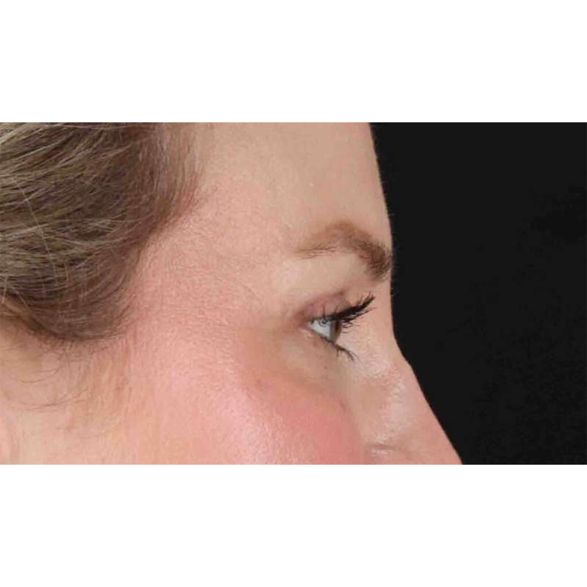 Blepharoplasty (Eyelid Surgery) Before & After Patient #10683