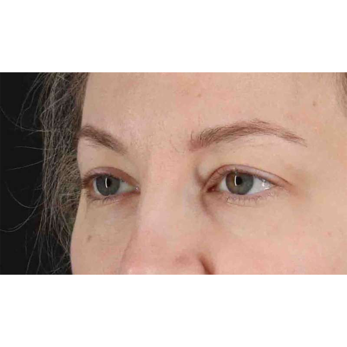 Blepharoplasty (Eyelid Surgery) Before & After Patient #10683