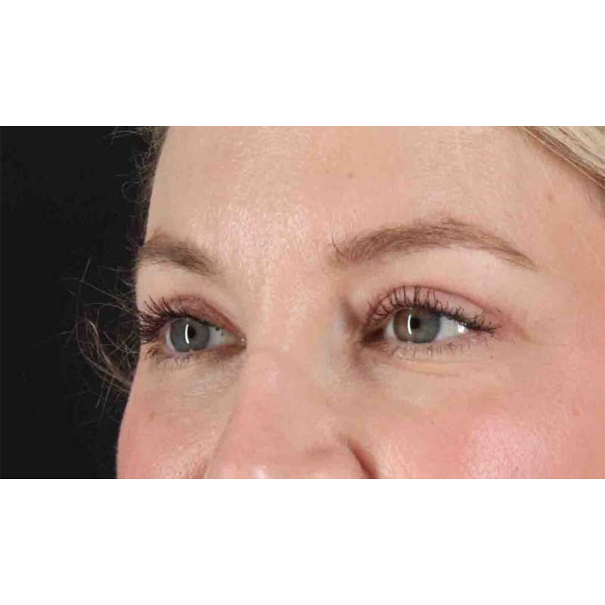 Blepharoplasty (Eyelid Surgery) Before & After Patient #10683