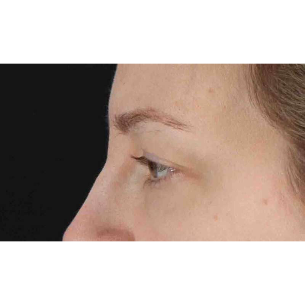 Blepharoplasty (Eyelid Surgery) Before & After Patient #10683