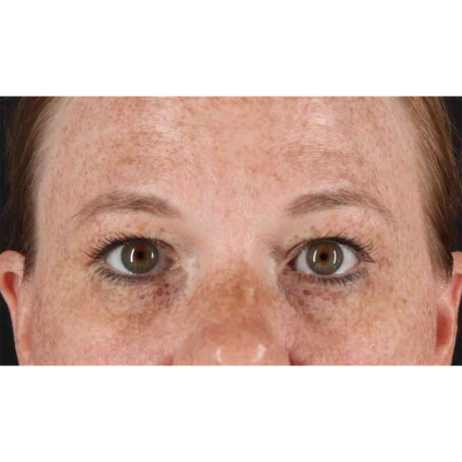 Blepharoplasty (Eyelid Surgery) Before & After Patient #10672