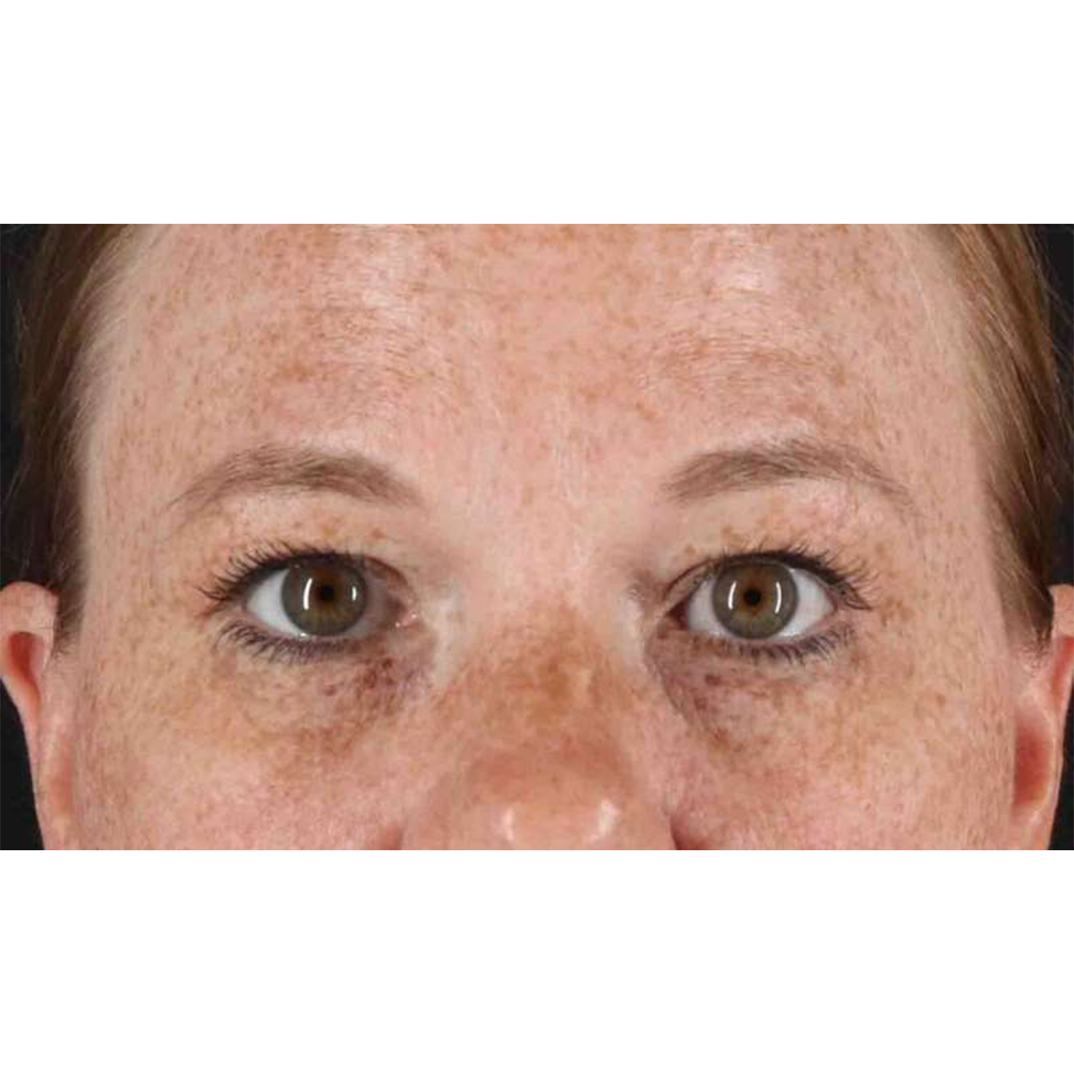 Blepharoplasty (Eyelid Surgery) Before & After Patient #10672
