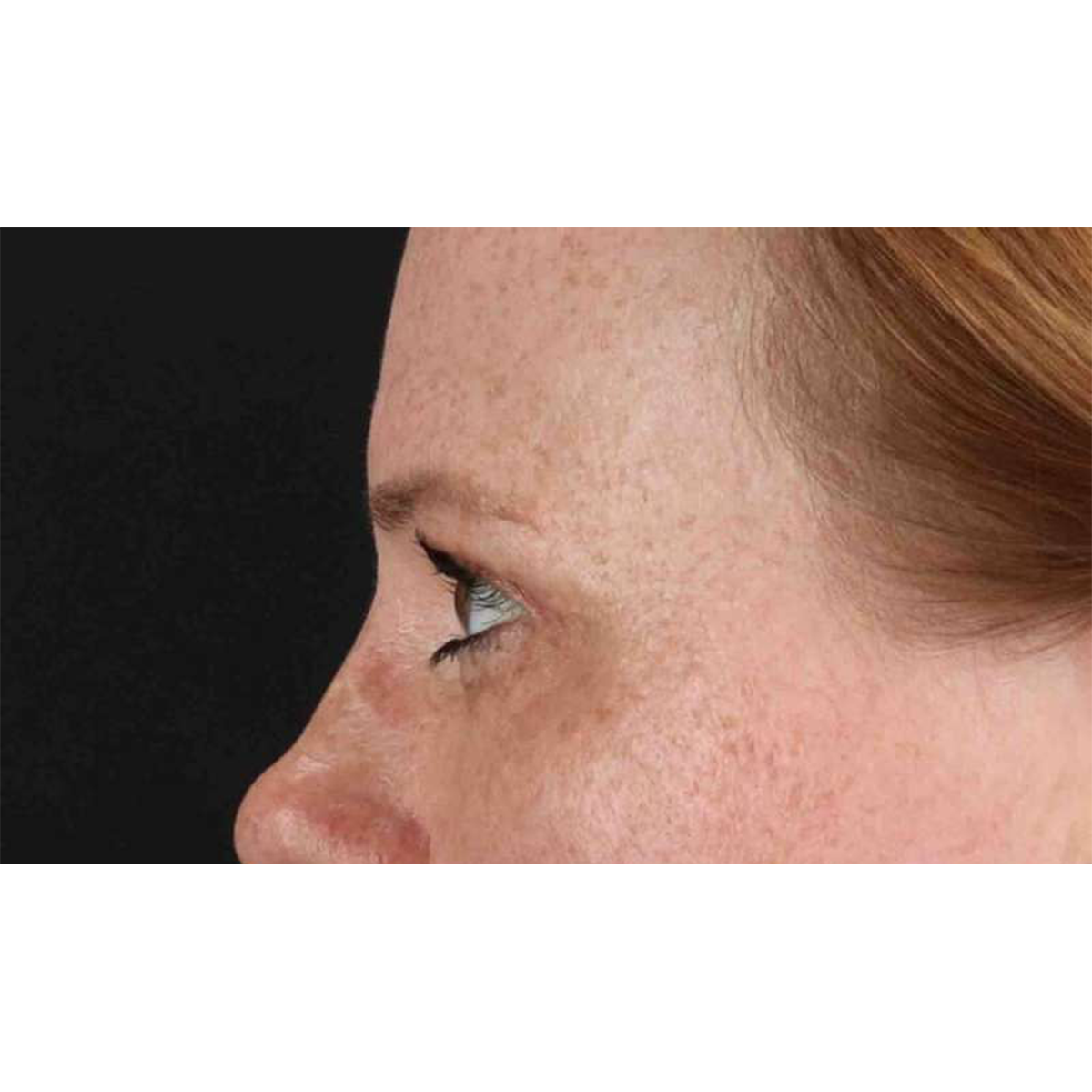 Blepharoplasty (Eyelid Surgery) Before & After Patient #10672