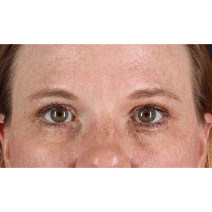 Blepharoplasty (Eyelid Surgery) Before & After Patient #10672