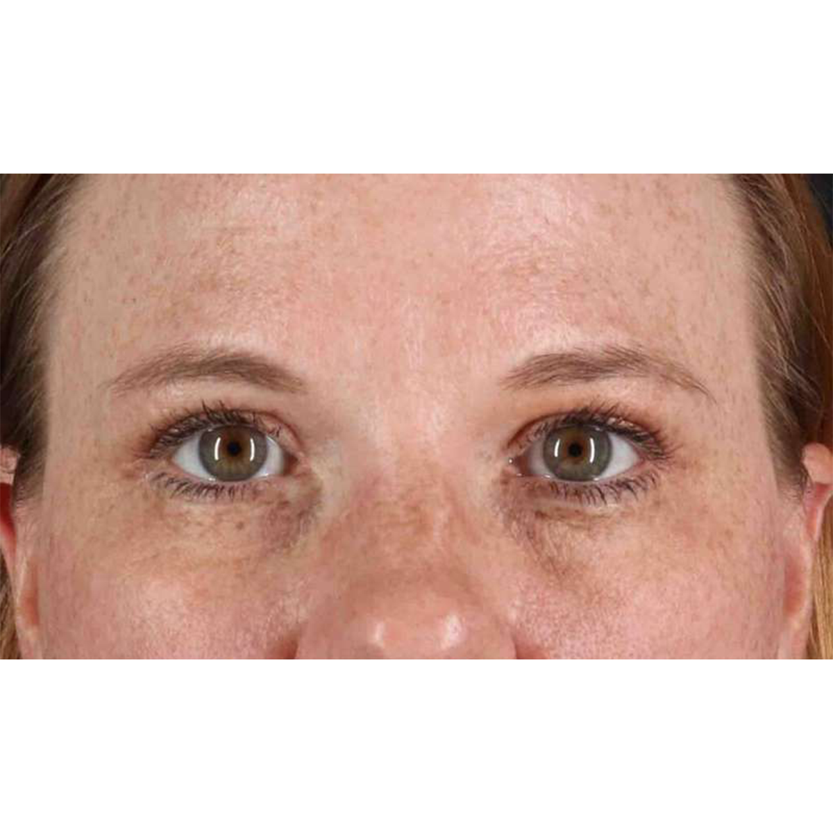 Blepharoplasty (Eyelid Surgery) Before & After Patient #10672