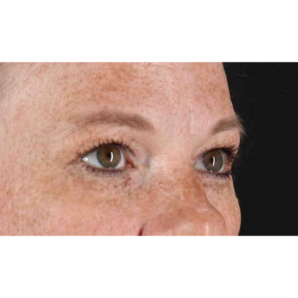 Blepharoplasty (Eyelid Surgery) Before & After Patient #10672
