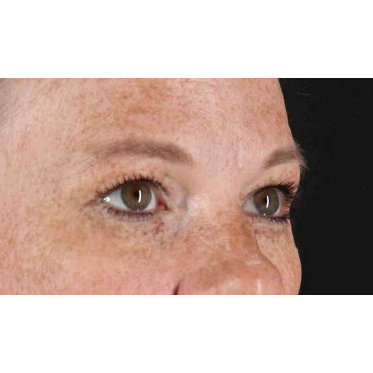 Blepharoplasty (Eyelid Surgery) Before & After Patient #10672