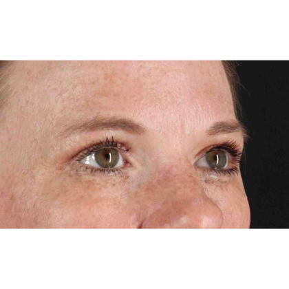 Blepharoplasty (Eyelid Surgery) Before & After Patient #10672