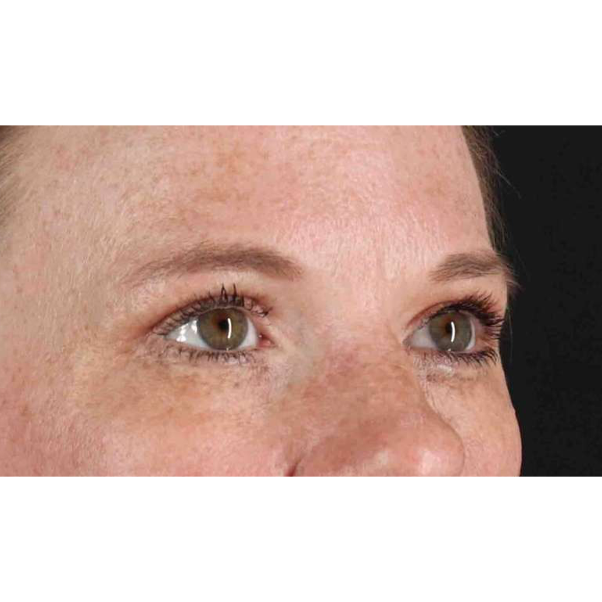 Blepharoplasty (Eyelid Surgery) Before & After Patient #10672