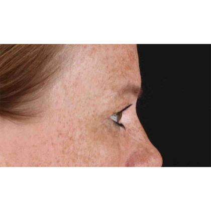 Blepharoplasty (Eyelid Surgery) Before & After Patient #10672