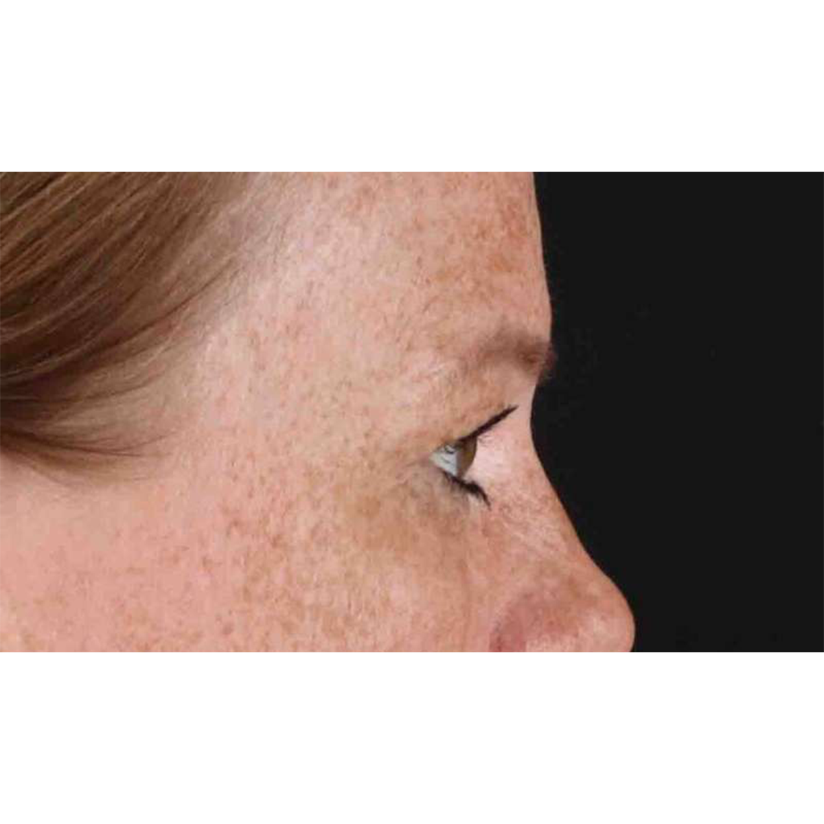 Blepharoplasty (Eyelid Surgery) Before & After Patient #10672