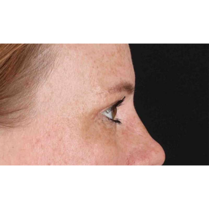 Blepharoplasty (Eyelid Surgery) Before & After Patient #10672