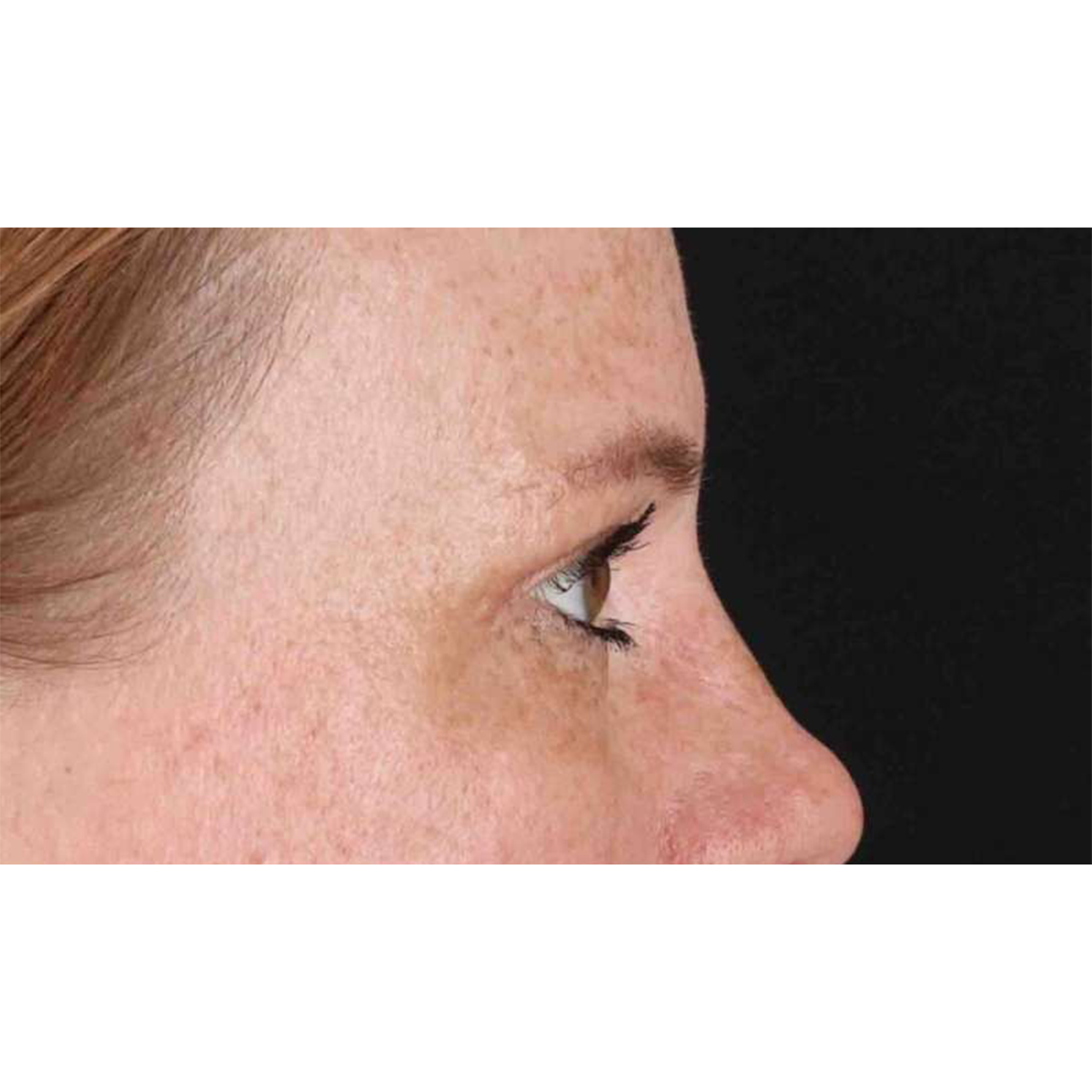 Blepharoplasty (Eyelid Surgery) Before & After Patient #10672