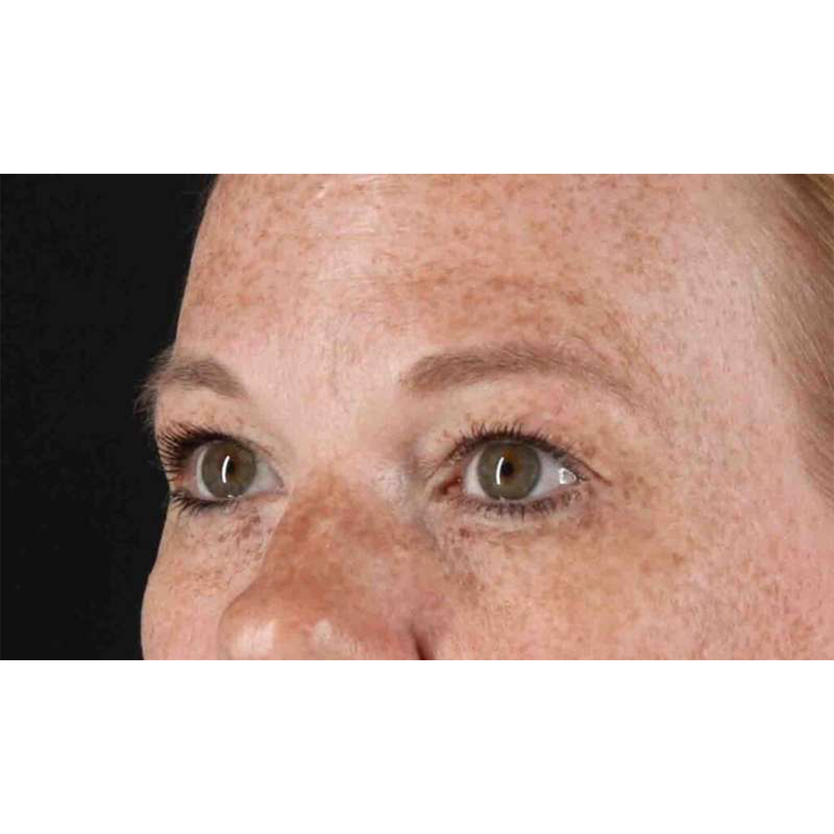 Blepharoplasty (Eyelid Surgery) Before & After Patient #10672