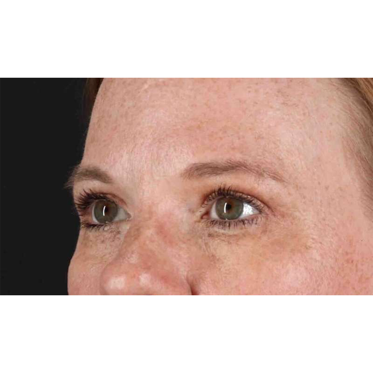 Blepharoplasty (Eyelid Surgery) Before & After Patient #10672