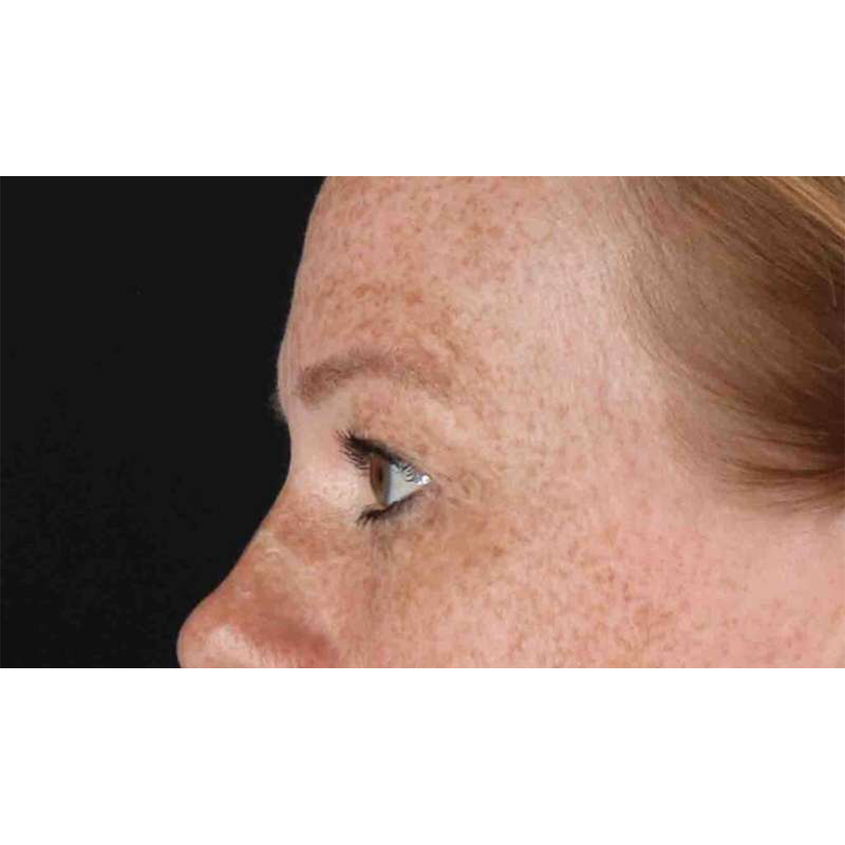 Blepharoplasty (Eyelid Surgery) Before & After Patient #10672