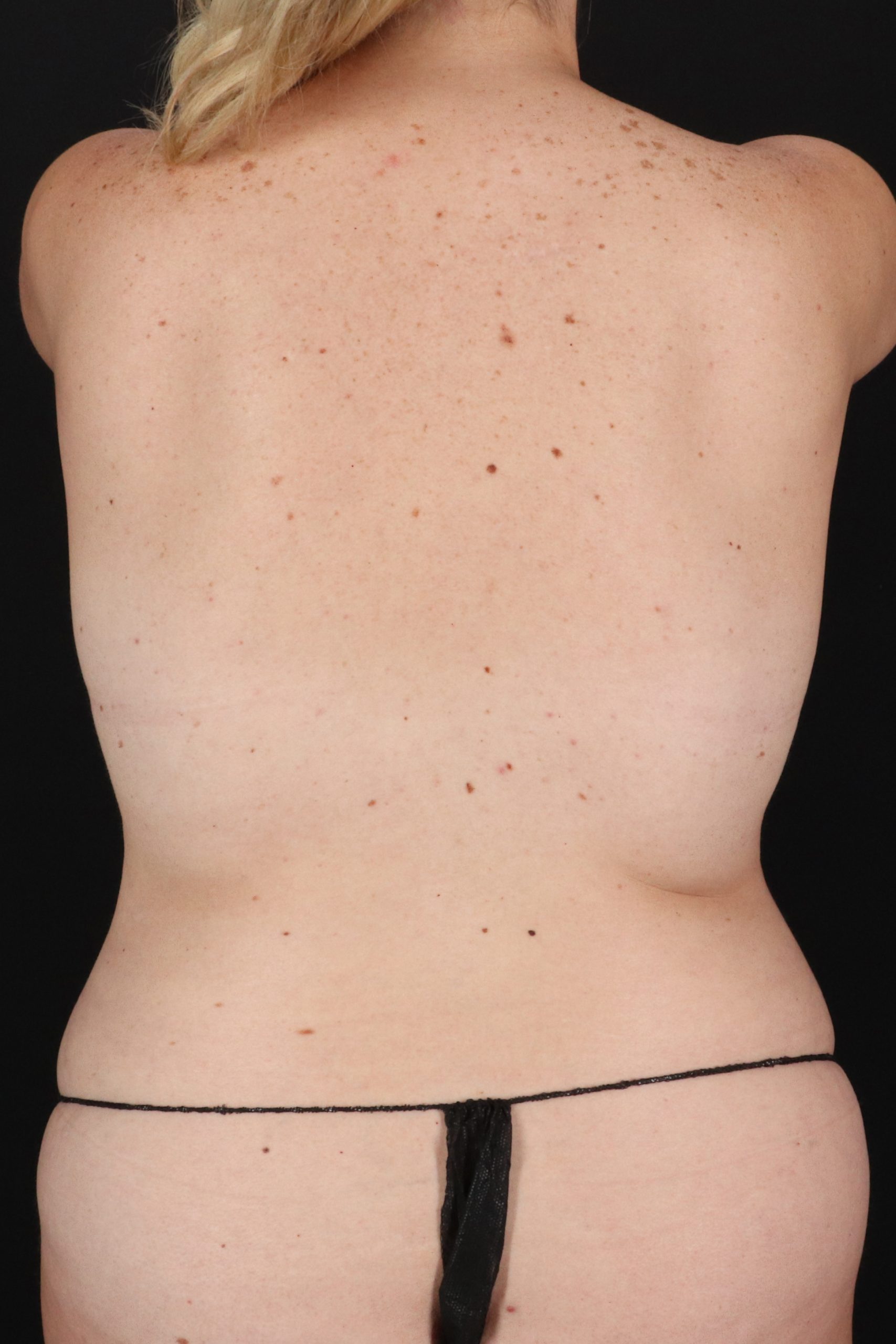All Me Augmentation Before & After Patient #10281