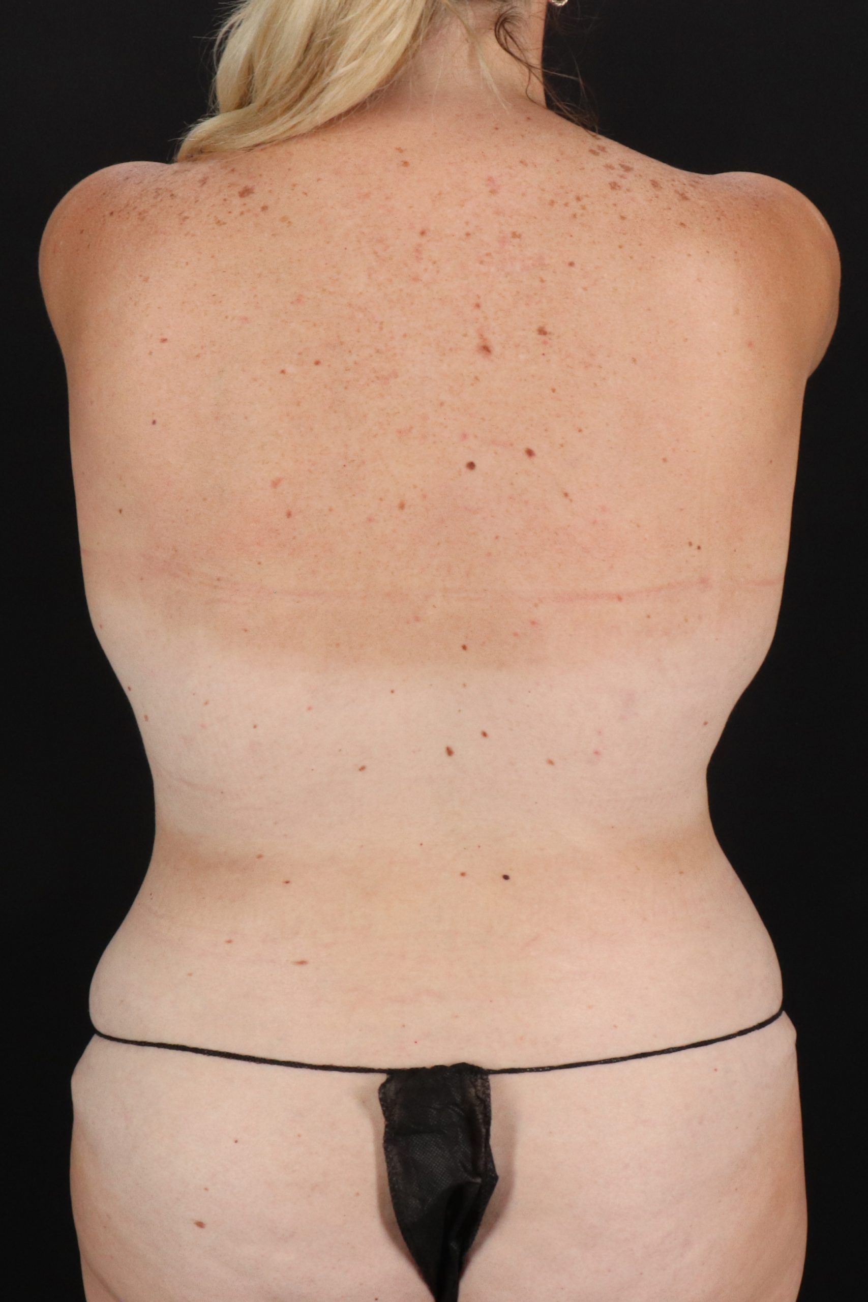 All Me Augmentation Before & After Patient #10281