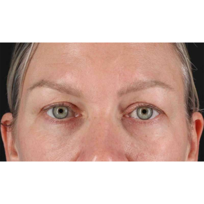 Blepharoplasty (Eyelid Surgery) Before & After Patient #10661